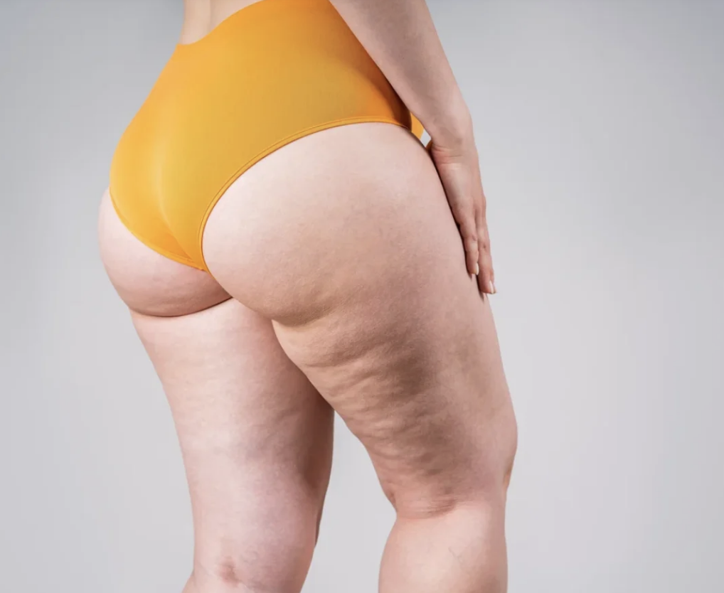 LIPEDEMA quase exclusivamente MULHERES