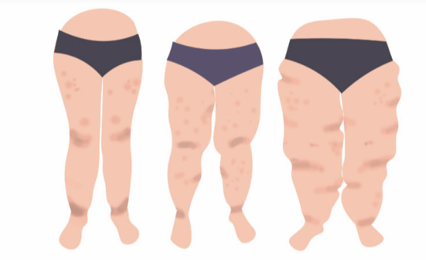 Evolução do LIPEDEMA se não tratado
