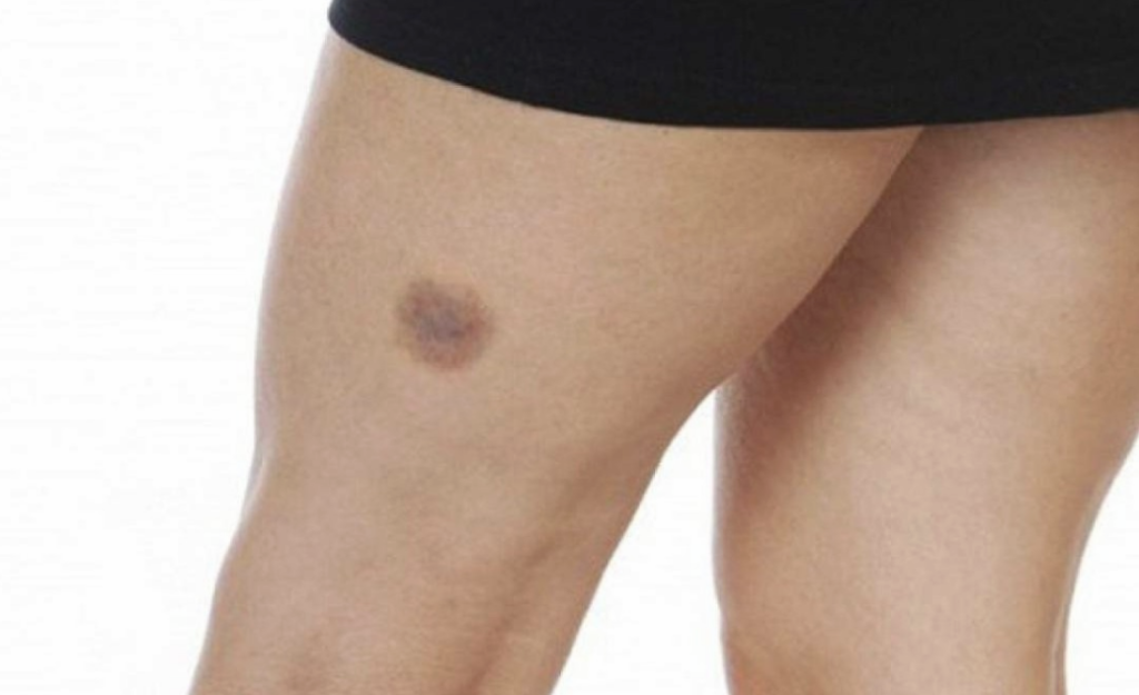 Hematomas nas pernas que aparecem espontameamente podem ser LIPEDEMA